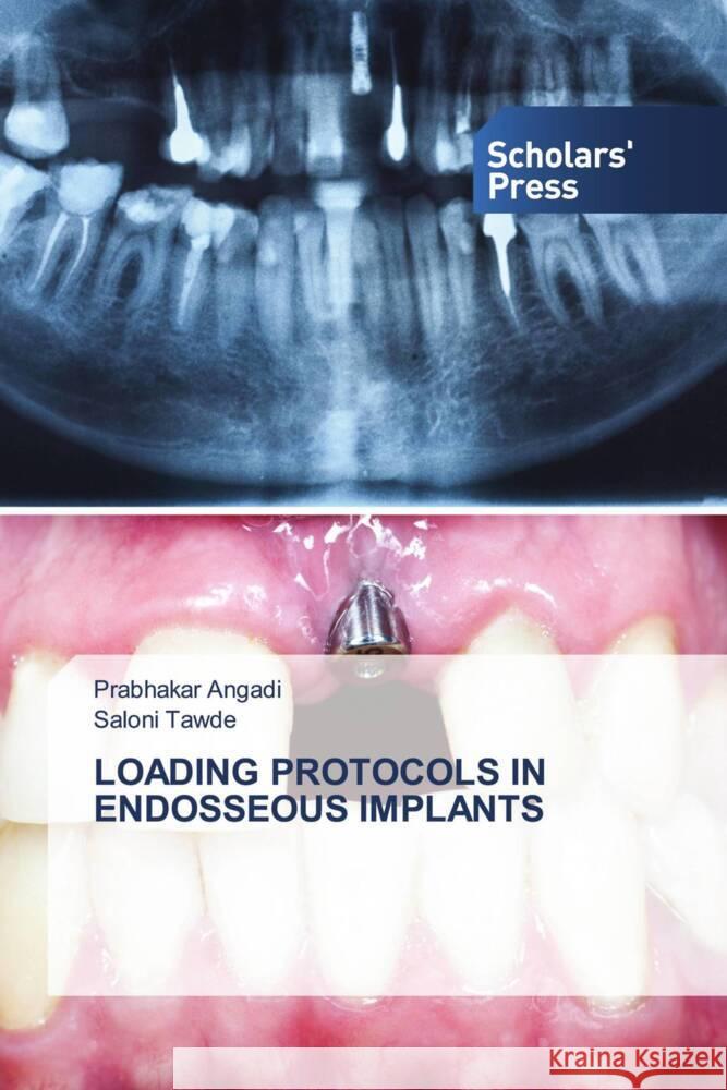 Loading Protocols in Endosseous Implants Prabhakar Angadi Saloni Tawde 9786205521724