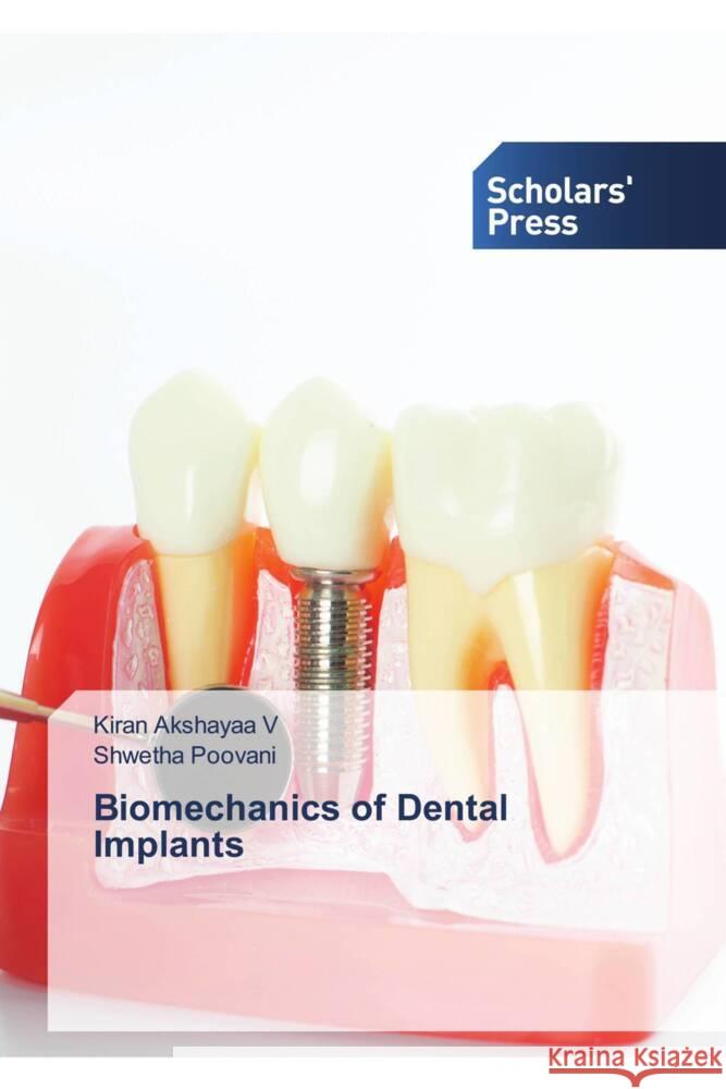 Biomechanics of Dental Implants Kiran Akshaya Shwetha Poovani 9786205521748