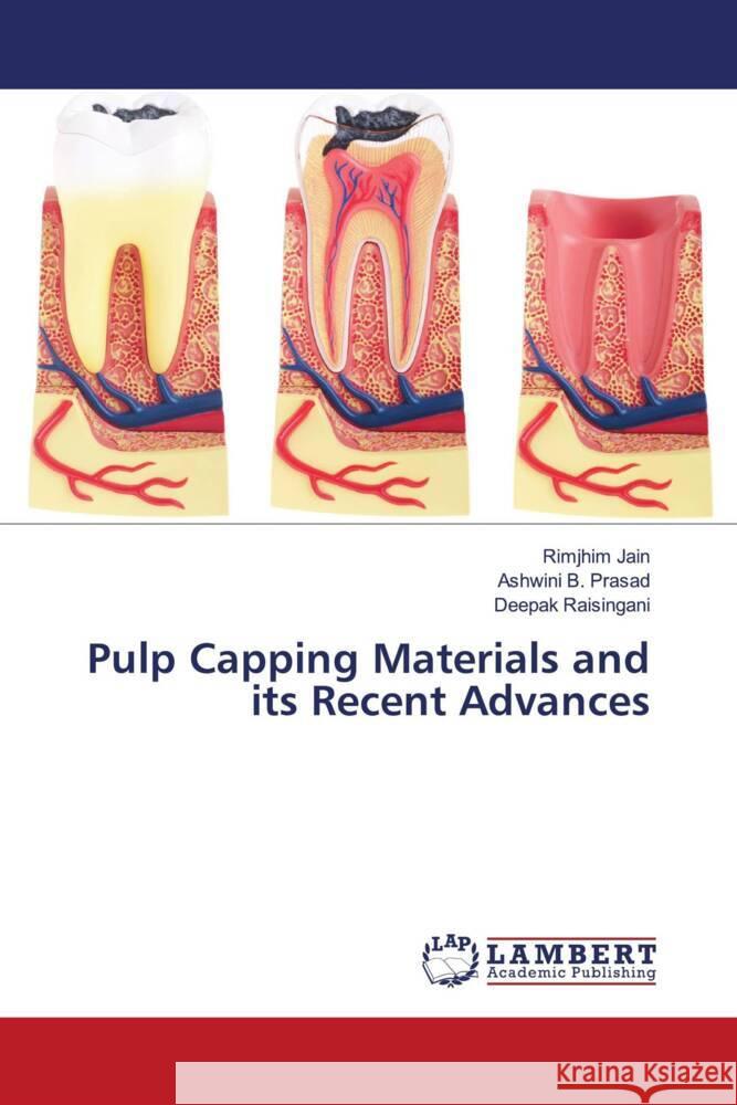 Pulp Capping Materials and its Recent Advances Jain, Rimjhim, B. Prasad, Ashwini, Raisingani, Deepak 9786205525548