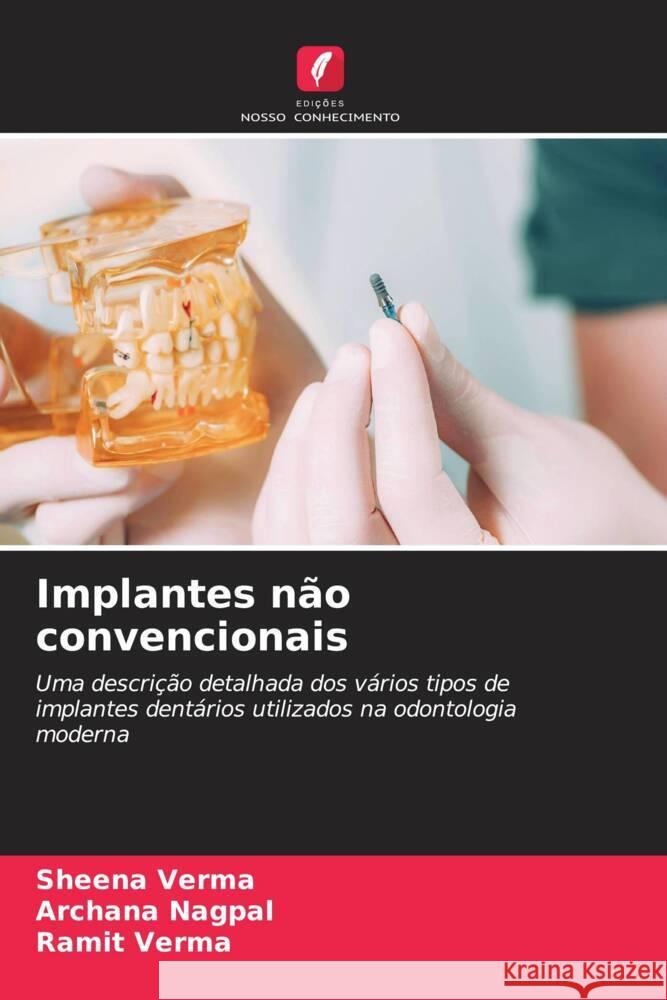 Implantes não convencionais Verma, Sheena, Nagpal, Archana, verma, Ramit 9786205557761