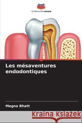 Les mesaventures endodontiques Megna Bhatt   9786205613023