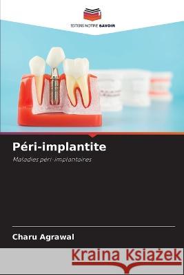 P?ri-implantite Charu Agrawal 9786205629840 Editions Notre Savoir