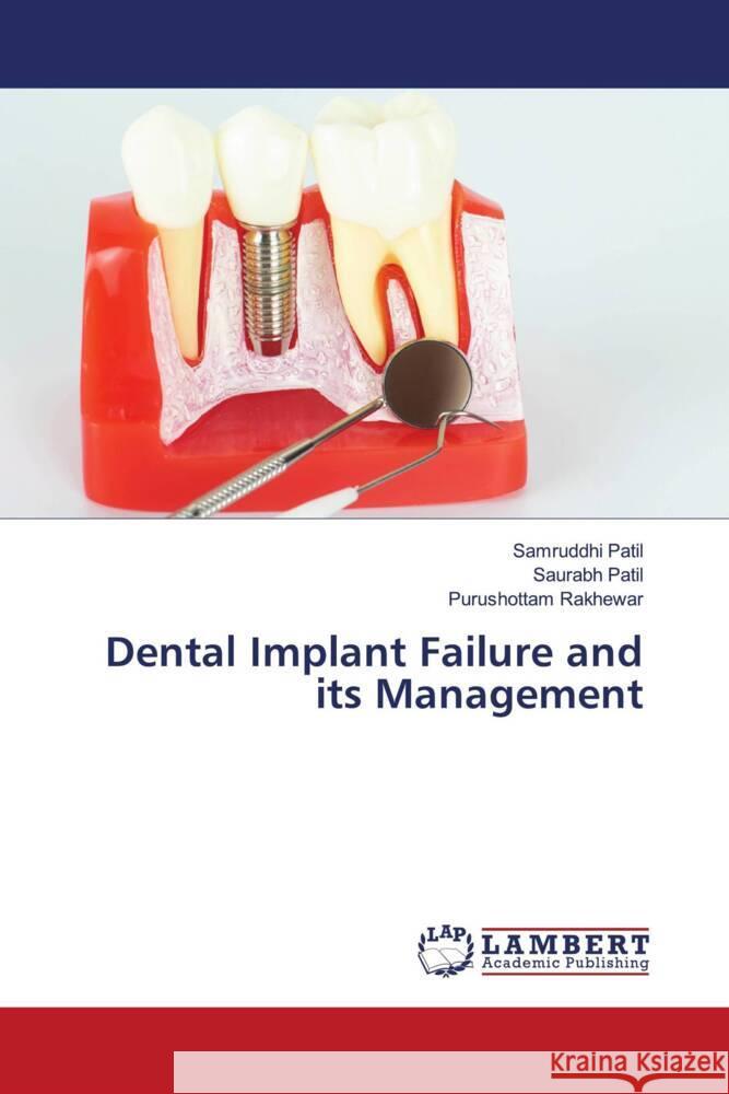 Dental Implant Failure and its Management Patil, Samruddhi, Patil, Saurabh, Rakhewar, Purushottam 9786205639160