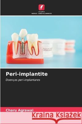 Peri-implantite Charu Agrawal 9786205642580 Edicoes Nosso Conhecimento