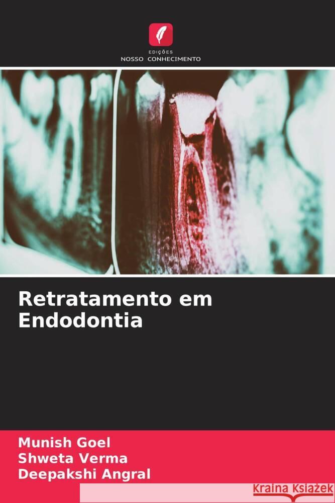 Retratamento em Endodontia Munish Goel Shweta Verma Deepakshi Angral 9786205809020