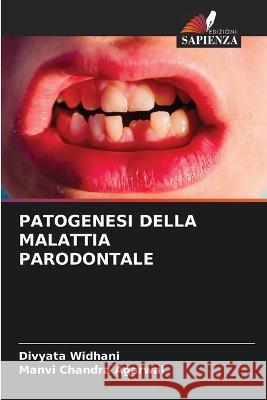 Patogenesi Della Malattia Parodontale Divyata Widhani Manvi Chandra Agarwal  9786205871508
