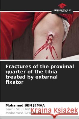 Fractures of the proximal quarter of the tibia treated by external fixator Mohamed Ben Jemaa Sami Sellami Mohamed Ghorbel 9786205898802 Our Knowledge Publishing