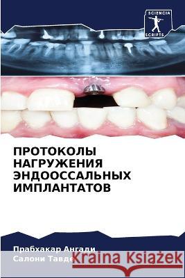 PROTOKOLY NAGRUZhENIYa JeNDOOSSAL'NYH IMPLANTATOV Angadi, Prabhakar, Tawde, Saloni 9786205934821