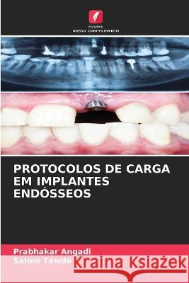 Protocolos de Carga Em Implantes Endosseos Prabhakar Angadi Saloni Tawde  9786205934852
