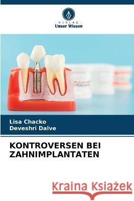 Kontroversen Bei Zahnimplantaten Lisa Chacko Deveshri Dalve  9786205976807
