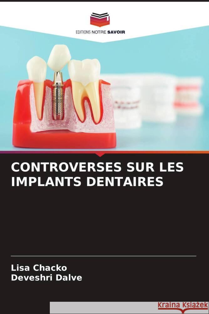 Controverses Sur Les Implants Dentaires Lisa Chacko Deveshri Dalve  9786205976814 Editions Notre Savoir