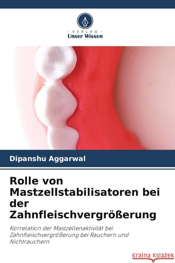 Rolle von Mastzellstabilisatoren bei der Zahnfleischvergrößerung Aggarwal, Dipanshu 9786206032359