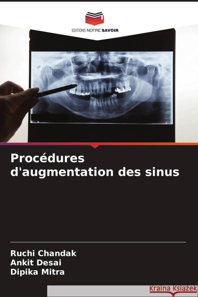 Procedures d'augmentation des sinus Ruchi Chandak Ankit Desai Dipika Mitra 9786206045410 Editions Notre Savoir