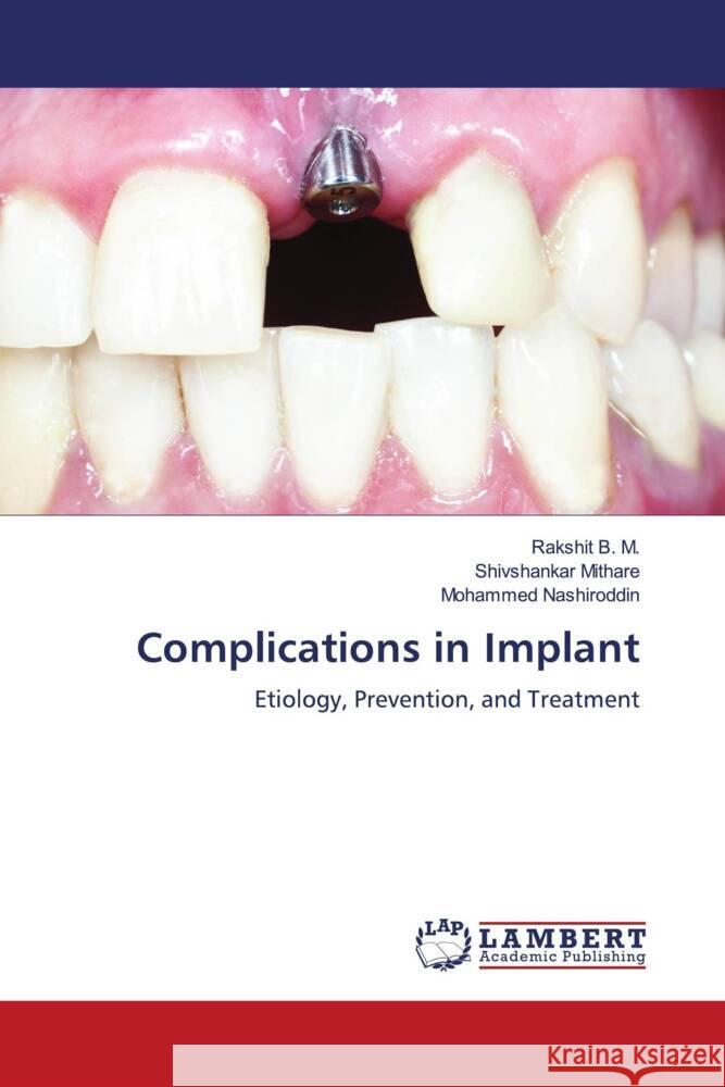 Complications in Implant B. M., Rakshit, Mithare, Shivshankar, Nashiroddin, Mohammed 9786206144236 LAP Lambert Academic Publishing