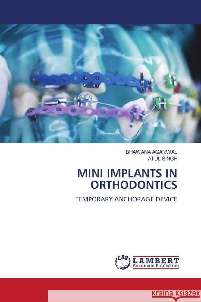 MINI IMPLANTS IN ORTHODONTICS Agarwal, Bhawana, Singh, Atul 9786206173038