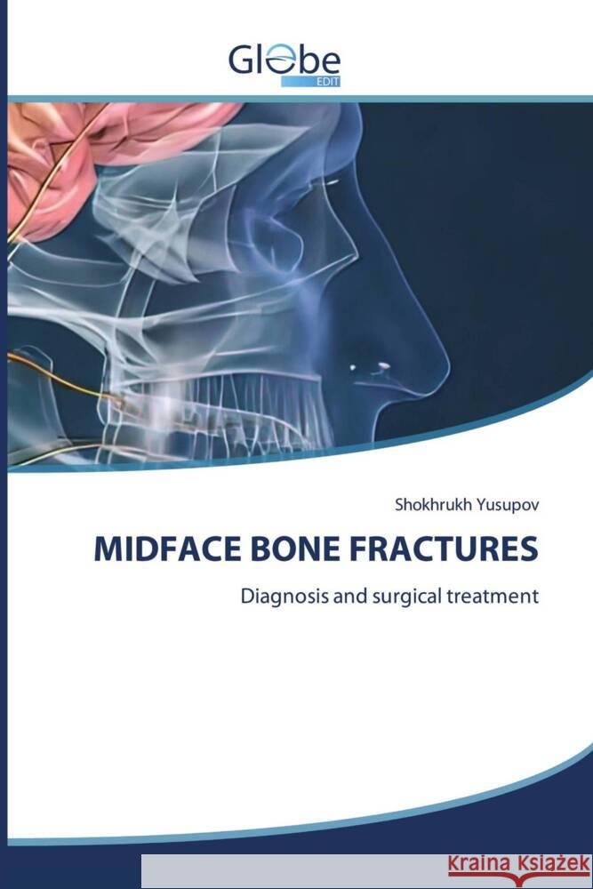 Midface Bone Fractures Shokhrukh Yusupov 9786206177685