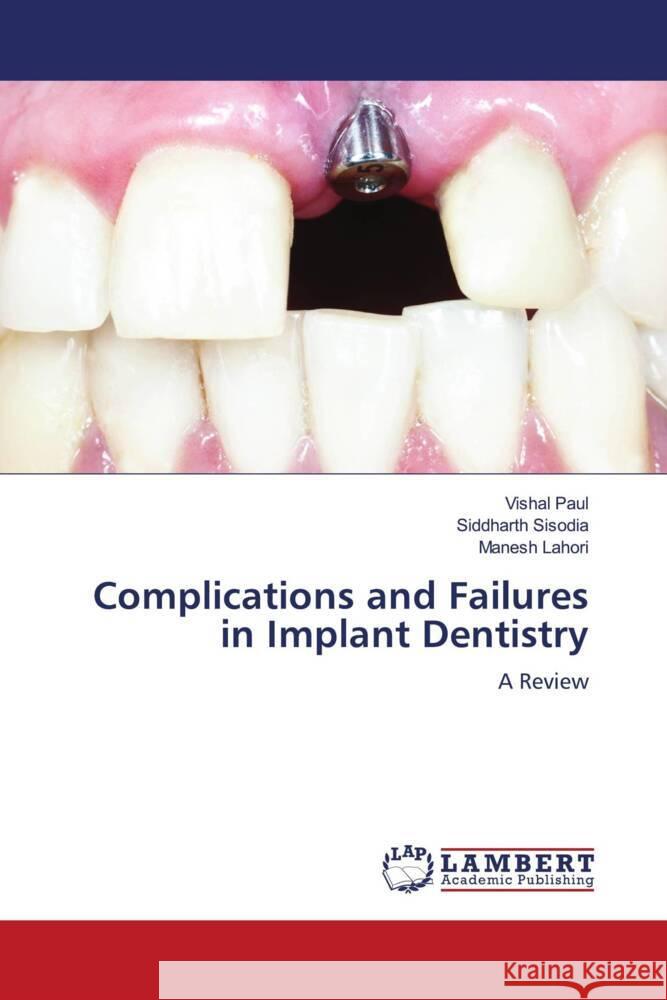 Complications and Failures in Implant Dentistry Paul, Vishal, Sisodia, Siddharth, Lahori, Manesh 9786206178606