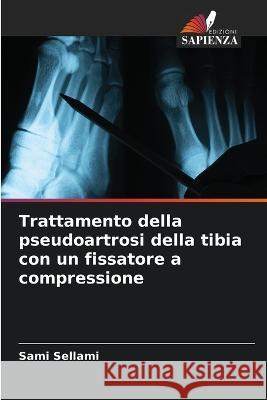 Trattamento della pseudoartrosi della tibia con un fissatore a compressione Sami Sellami   9786206209942