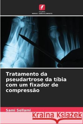 Tratamento da pseudartrose da tibia com um fixador de compressao Sami Sellami   9786206209959