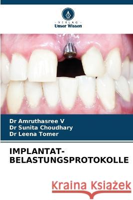 Implantat-Belastungsprotokolle Dr Amruthasree V Dr Sunita Choudhary Dr Leena Tomer 9786206247678 Verlag Unser Wissen