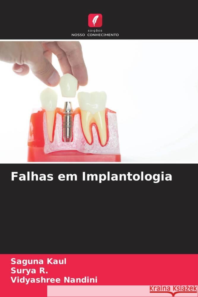 Falhas em Implantologia Kaul, Saguna, R., Surya, Nandini, Vidyashree 9786206307037