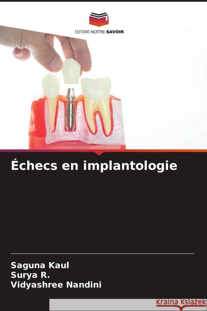 Échecs en implantologie Kaul, Saguna, R., Surya, Nandini, Vidyashree 9786206307099
