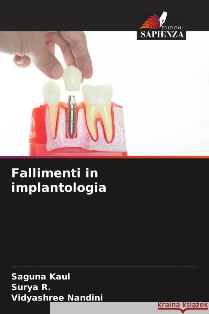 Fallimenti in implantologia Kaul, Saguna, R., Surya, Nandini, Vidyashree 9786206307136