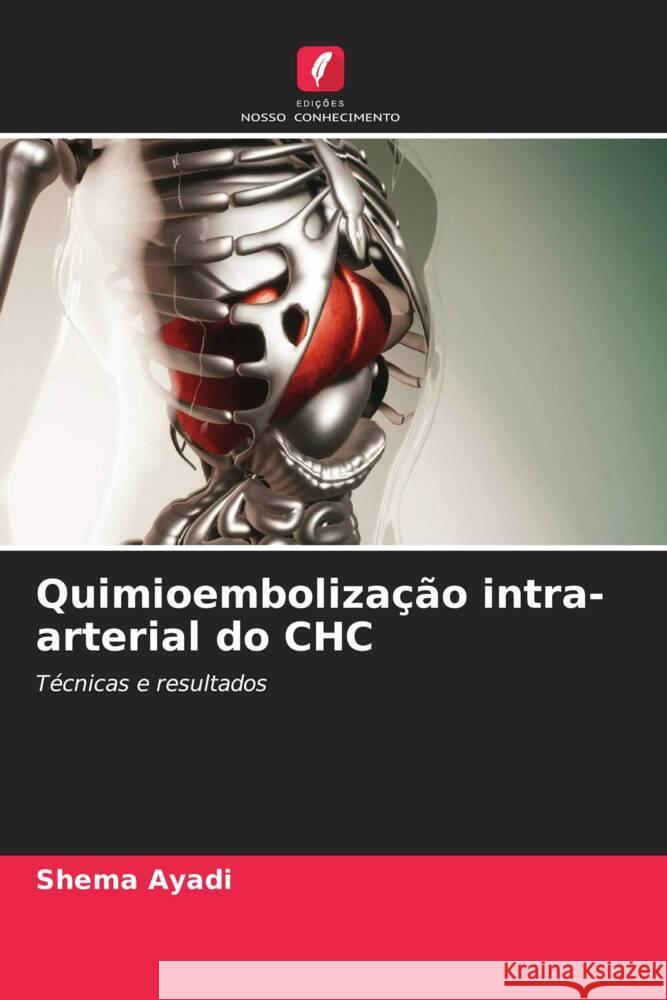 Quimioembolização intra-arterial do CHC Ayadi, Shema 9786206325178