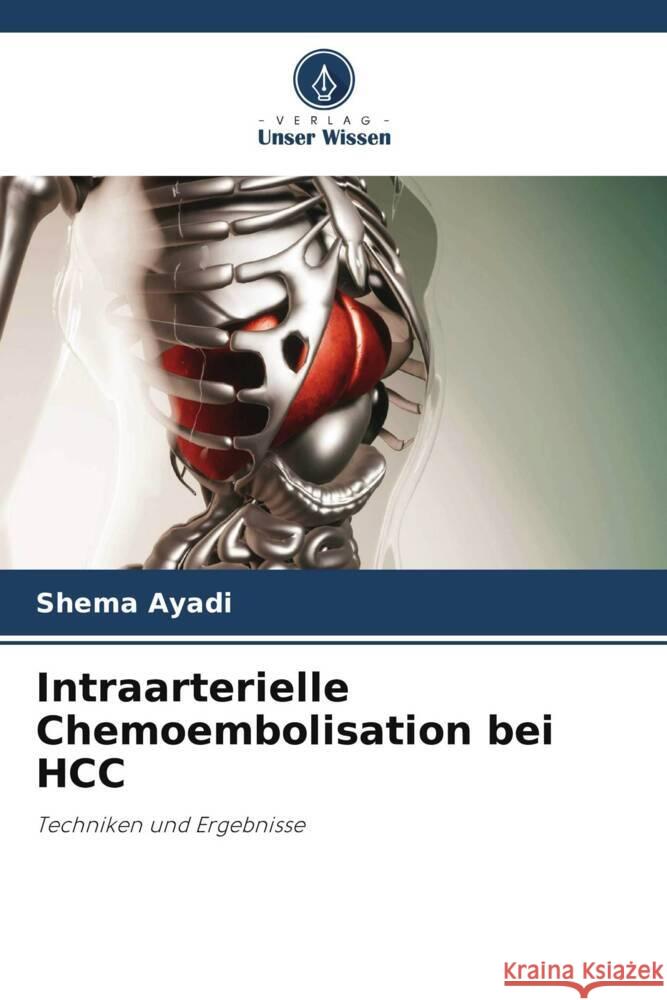 Intraarterielle Chemoembolisation bei HCC Ayadi, Shema 9786206325185