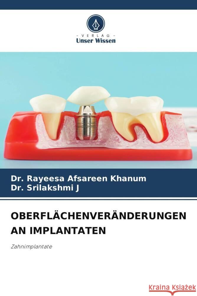 OBERFLÄCHENVERÄNDERUNGEN AN IMPLANTATEN Khanum, Dr. Rayeesa Afsareen, J, Dr. Srilakshmi 9786206355793