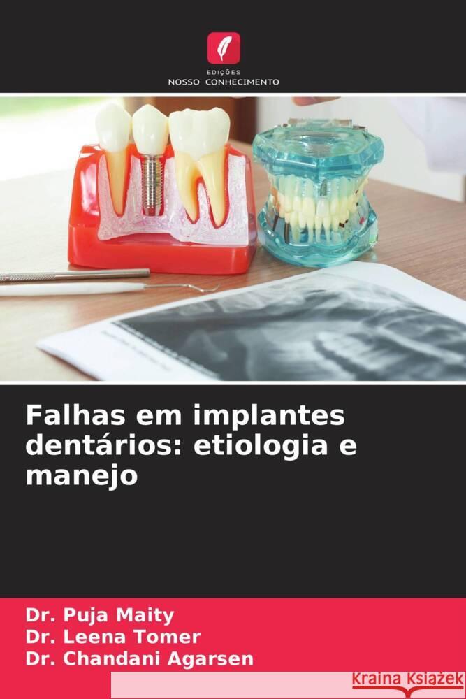 Falhas em implantes dentários: etiologia e manejo Maity, Dr. Puja, Tomer, Dr. Leena, Agarsen, Dr. Chandani 9786206369158