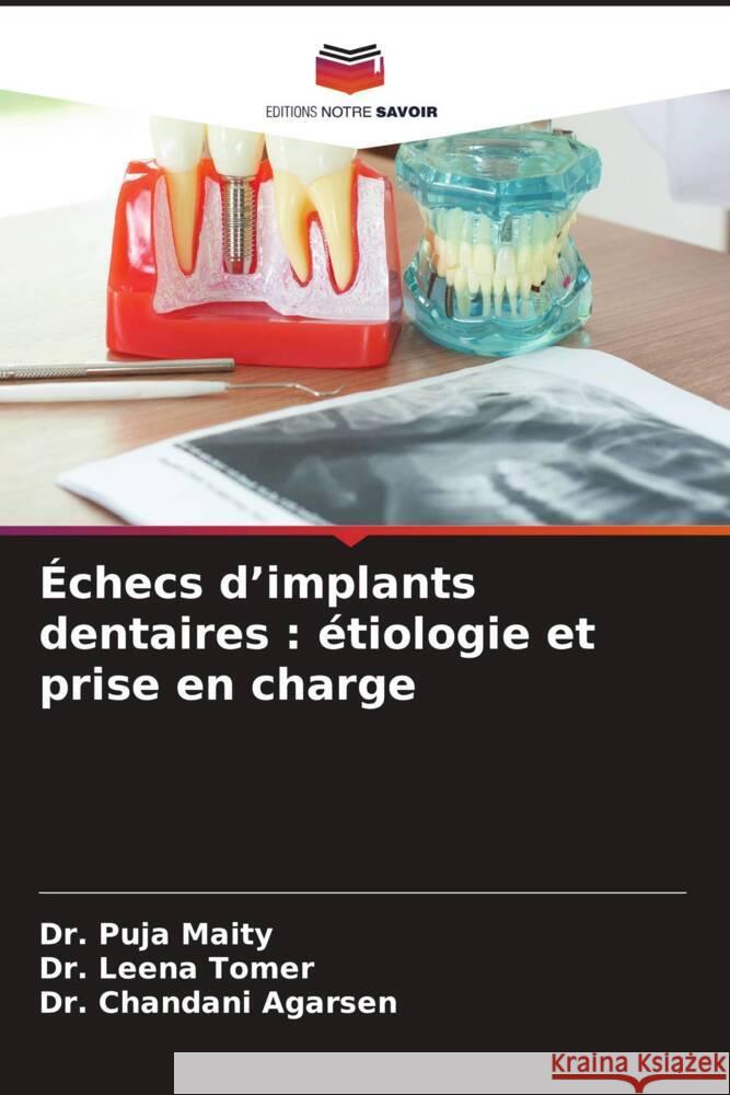 Échecs d'implants dentaires : étiologie et prise en charge Maity, Dr. Puja, Tomer, Dr. Leena, Agarsen, Dr. Chandani 9786206369189