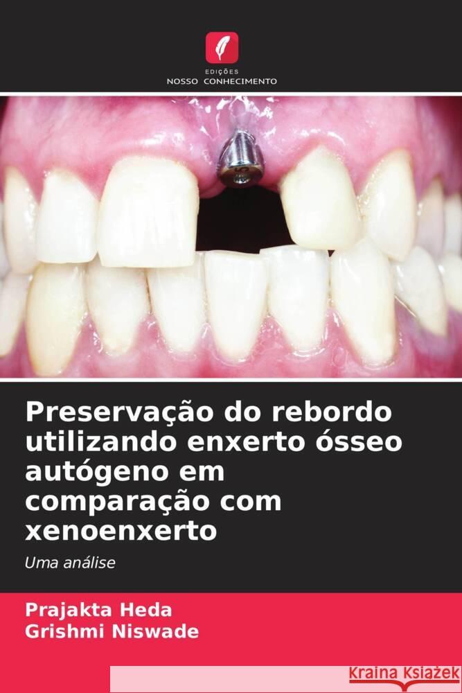 Preservação do rebordo utilizando enxerto ósseo autógeno em comparação com xenoenxerto Heda, Prajakta, Niswade, Grishmi 9786206380986