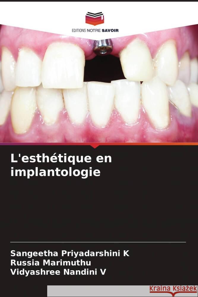 L'esthétique en implantologie K, Sangeetha Priyadarshini, Marimuthu, Russia, V, Vidyashree Nandini 9786206393399 Editions Notre Savoir