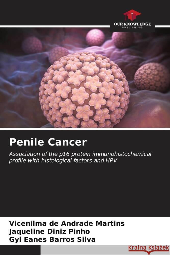 Penile Cancer de Andrade Martins, Vicenilma, Diniz Pinho, Jaqueline, Barros Silva, Gyl Eanes 9786206554073