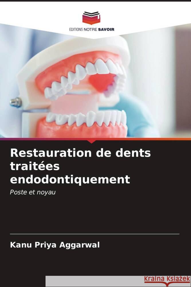 Restauration de dents traitées endodontiquement Aggarwal, Kanu Priya 9786206563686