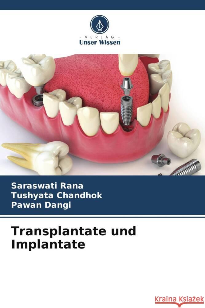 Transplantate und Implantate Rana, Saraswati, Chandhok, Tushyata, Dangi, Pawan 9786206575061 Verlag Unser Wissen