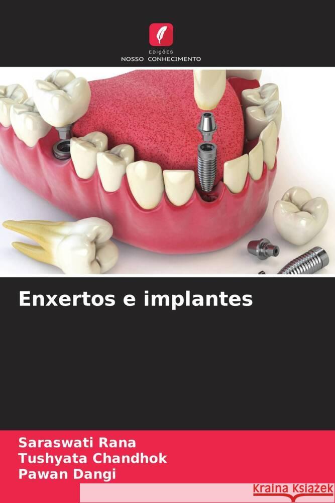 Enxertos e implantes Rana, Saraswati, Chandhok, Tushyata, Dangi, Pawan 9786206575108 Edições Nosso Conhecimento