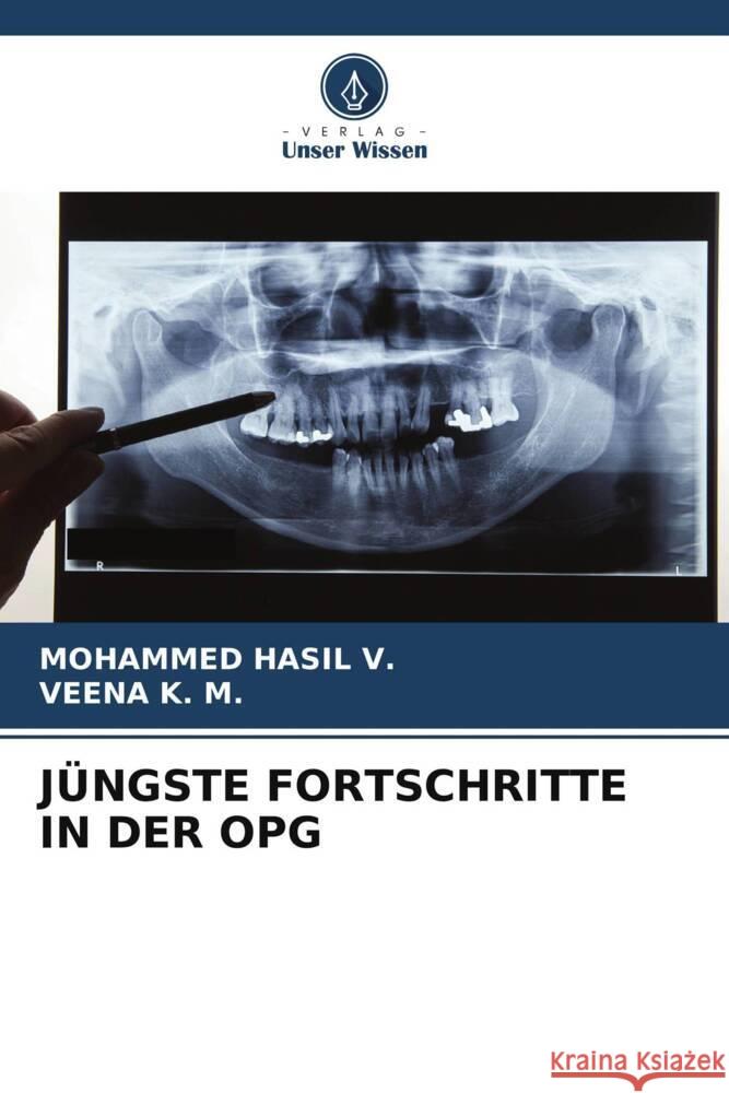 J?ngste Fortschritte in Der Opg Mohammed Hasi Veena K 9786206605256 Verlag Unser Wissen