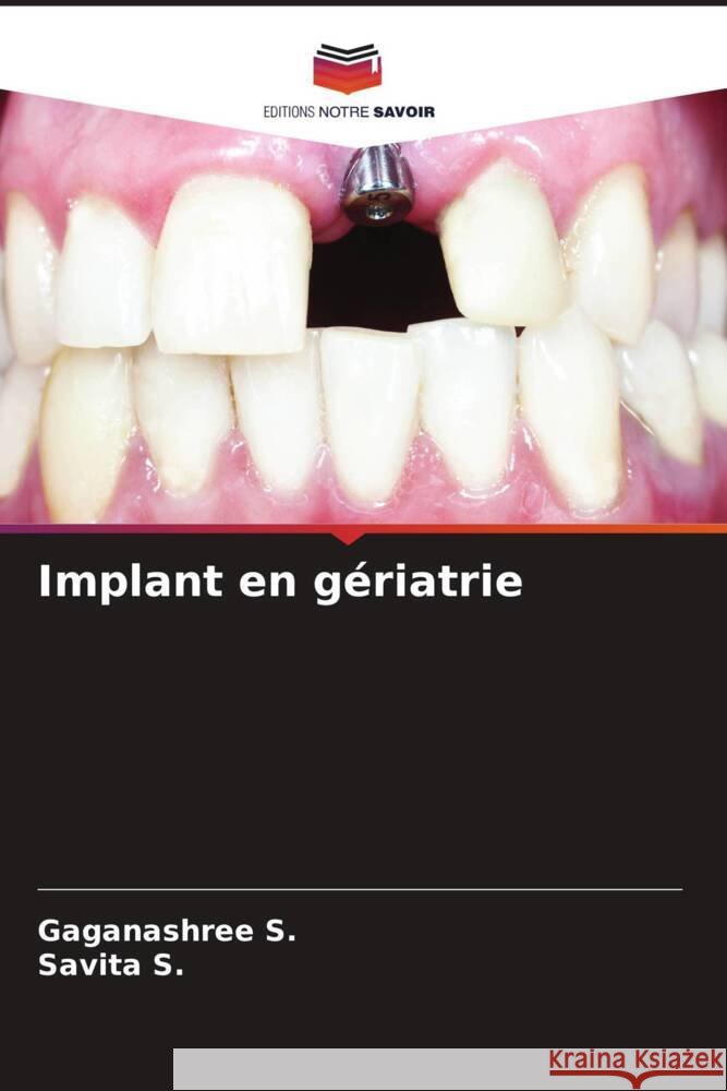 Implant en gériatrie S., Gaganashree, S., Savita 9786206608639 Editions Notre Savoir