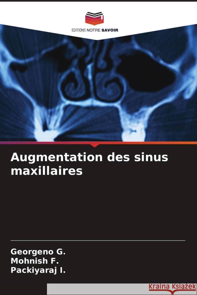 Augmentation des sinus maxillaires Georgeno G Mohnish F Packiyaraj I 9786206653738