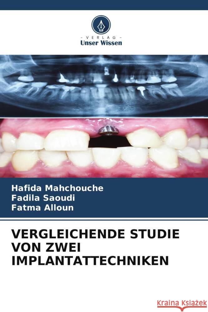 Vergleichende Studie Von Zwei Implantattechniken Hafida Mahchouche Fadila Saoudi Fatma Alloun 9786206659617