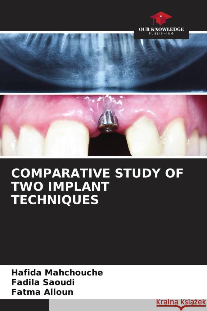 Comparative Study of Two Implant Techniques Hafida Mahchouche Fadila Saoudi Fatma Alloun 9786206659624