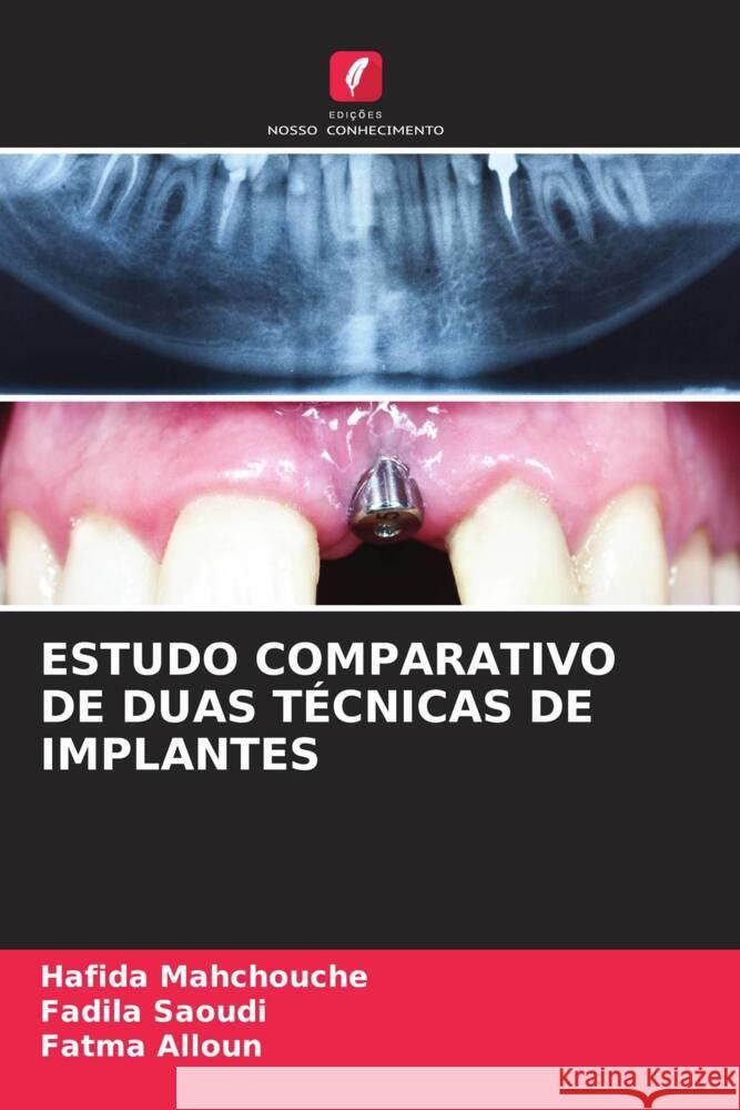 Estudo Comparativo de Duas T?cnicas de Implantes Hafida Mahchouche Fadila Saoudi Fatma Alloun 9786206659655