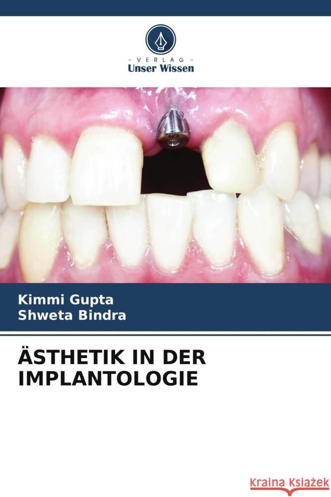 ?sthetik in Der Implantologie Kimmi Gupta Shweta Bindra 9786206670469