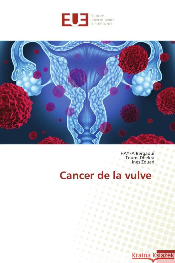 Cancer de la vulve Hayfa Bergaoui Toumi Dhekra Ines Zouari 9786206702238 Editions Universitaires Europeennes