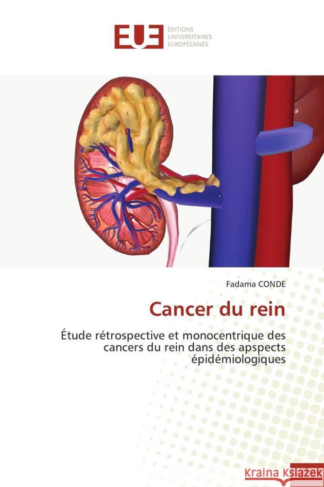 Cancer du rein CONDE, Fadama 9786206727224