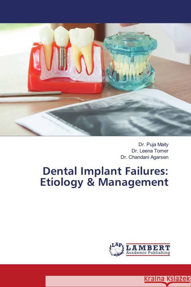 Dental Implant Failures: Etiology & Management Maity, Dr. Puja, Tomer, Dr. Leena, Agarsen, Dr. Chandani 9786206752509