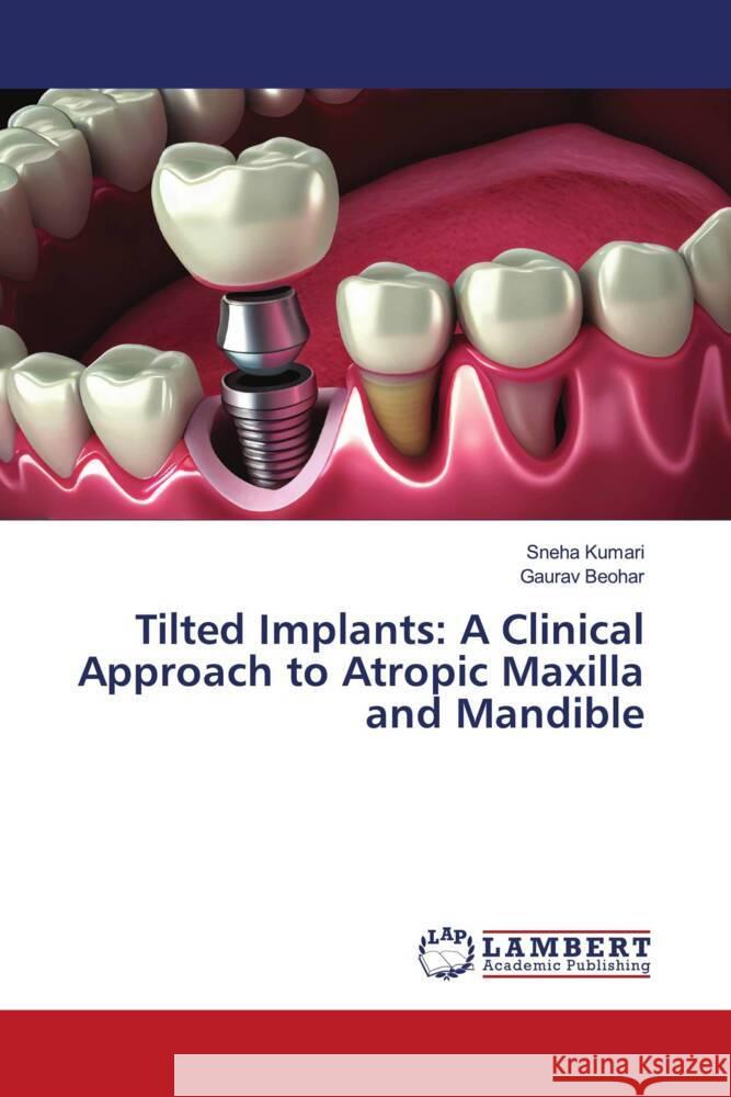 Tilted Implants: A Clinical Approach to Atropic Maxilla and Mandible Kumari, Sneha, Beohar, Gaurav 9786206844563 LAP Lambert Academic Publishing