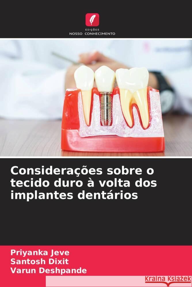 Considera??es sobre o tecido duro ? volta dos implantes dent?rios Priyanka Jeve Santosh Dixit Varun Deshpande 9786206854210